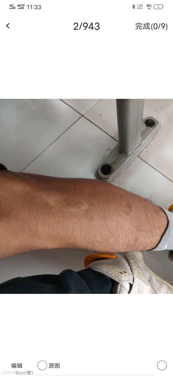 当兵疤痕要求及解读，当兵疤痕要求解读，标准与评估方法